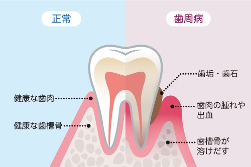 歯周病の原因と症状